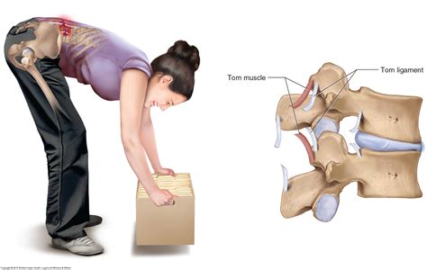 Back Sprains & Strains Causes, Symptoms & Treatments