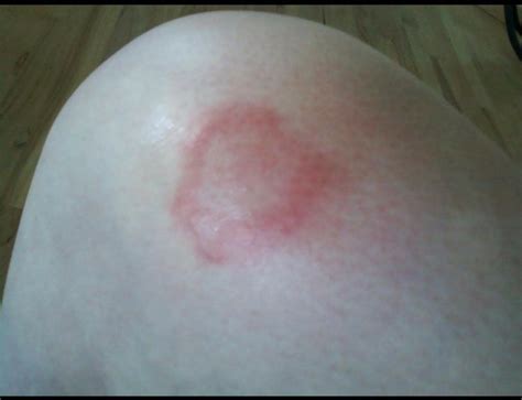 Lyme Disease Bullseye Skin Rash Tick Bite | Lyme Warrior | Lyme Warrior.