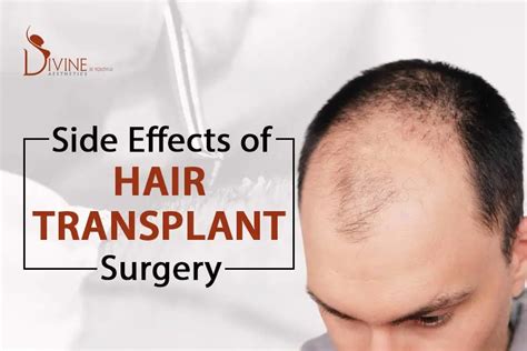 What are the Side Effects of Hair Transplant Surgery