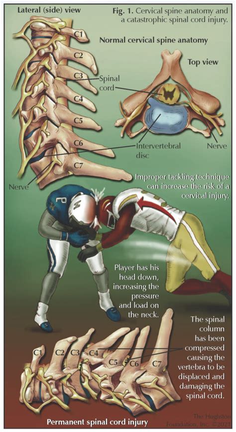 Cervical Spine Injuries in Sports - Hughston Clinic