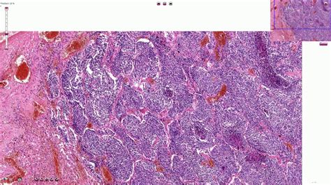 Lung Carcinoma Histology