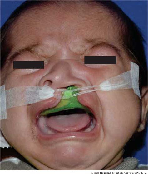 PDF] Presurgical Orthopedics In Cleft Lip And Palate Care, 46% OFF