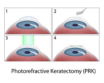 PRK Indianapolis | PRK Surgery Greenwood | Lanter EyeCare