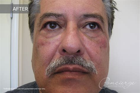 B and A - Juvederm Ultra Under Eyes (64 yo) | Concierge Aesthetics