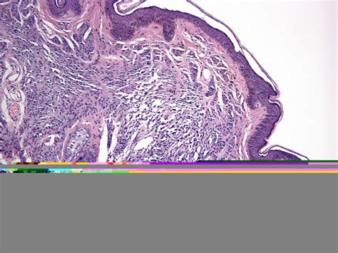 Congenital melanocytic nevus - Dermatology Advisor