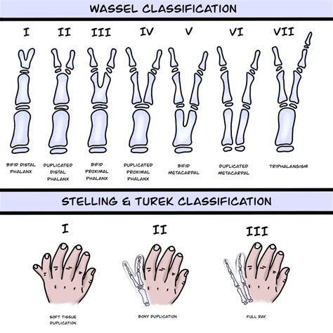 Supernumerary Digit - StatPearls - NCBI Bookshelf