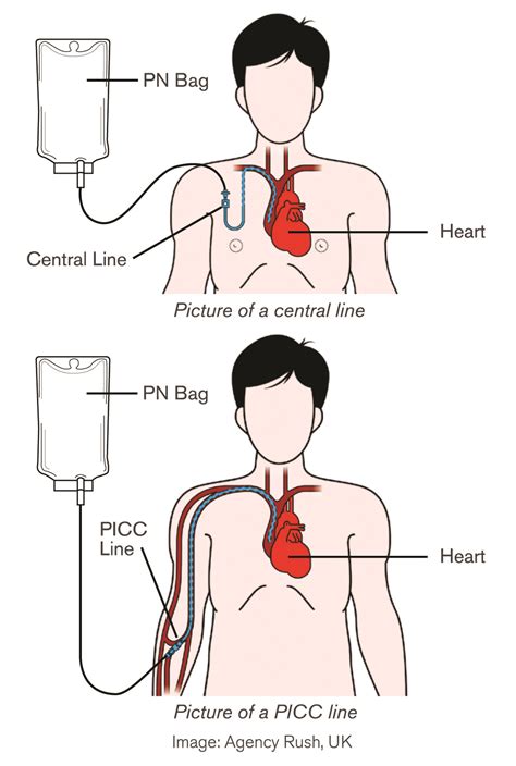 Parenteral nutrition fact sheet | | Agency for Clinical Innovation