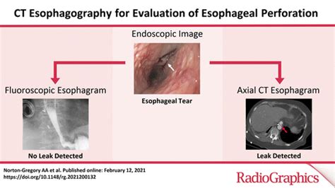 Marte seguridad Línea del sitio esophageal perforation labios espejo de ...