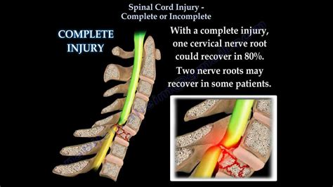 Spinal Cord Injury Complete Or Incomplete - Everything You Need To Know - Dr. Nabil Ebraheim ...