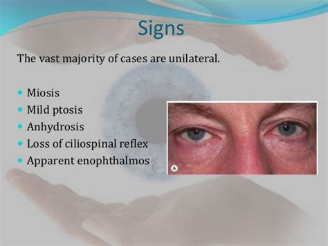 Horners syndrome