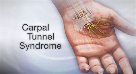 Carpal tunnel syndrome: Physiotherapy Treatment - Exercise | Samarpan