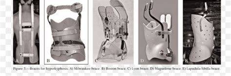 Scheuermann's Disease Milwaukee Brace Kyphosis Back Brace Scoliosis ...