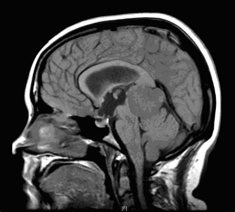 Large Pineal Meningioma Causing Loss of Vision in a Teenager | Walid | Journal of Medical Cases