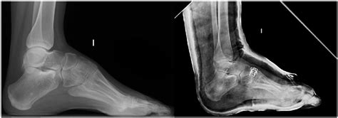 Severe cavovarus deformity treated by Tarsal osteotomy. | Download Scientific Diagram