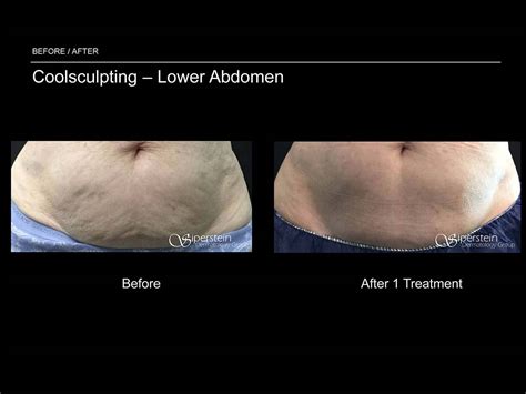 Before & After Photos Of Coolsculpting Treatment Results