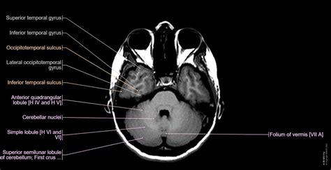 Cross-sectional anatomy of the brain: normal anatomy | e-Anatomy