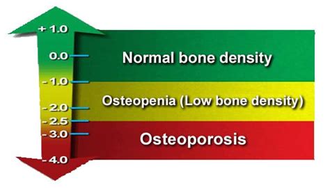 Bone Density Chart: Understand Your Bone Density Scores - University ...