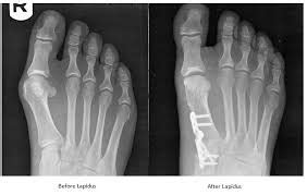 Traditional Surgery in Portland & Sandy, OR | Bunion Centers of Oregon