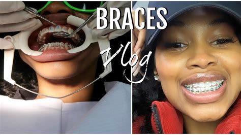 Best Way To Help Braces Pain : Ways To Ease Braces Pain Omar Orthodontics - This will help your ...