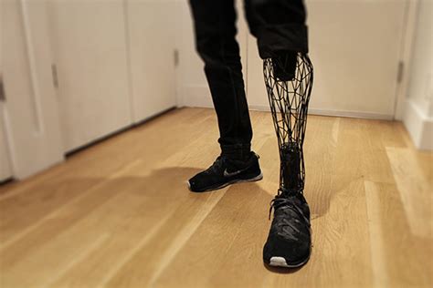 3D printed Exo-Prosthetic leg designed to be affordable – and beautiful