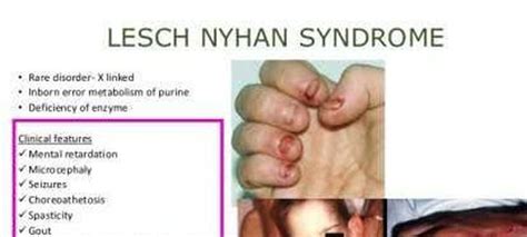 These are the clinical features of Lesch nyhan syndrome - MEDizzy