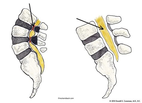 Lumbar Spinal Stenosis and Neurogenic Claudication - Welcome Back ...