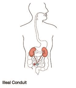 Essential Facts About Your Urostomy - Ostomy Care Canada