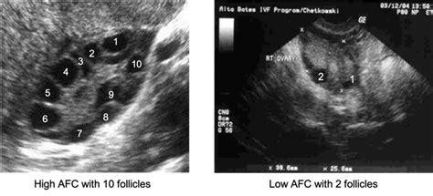 Normal Follicle Count By Age - Reproduction Online