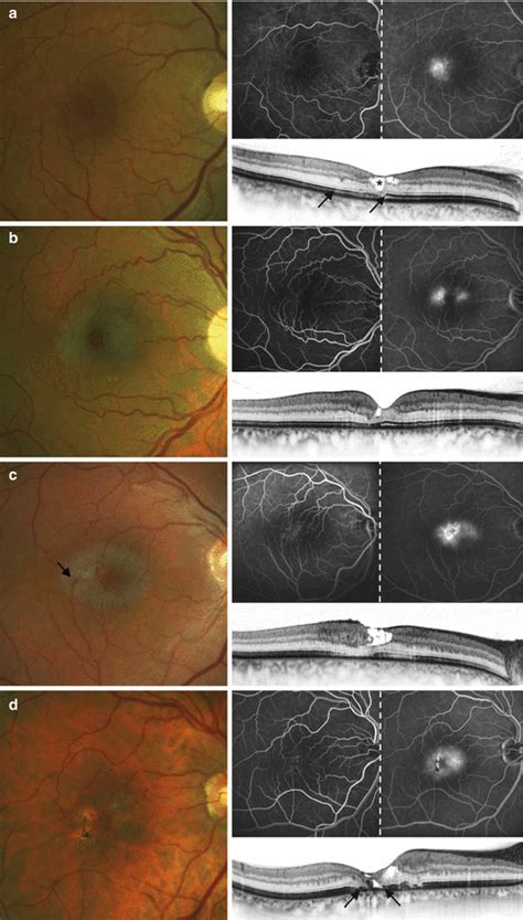 Macular Telangiectasia | SpringerLink