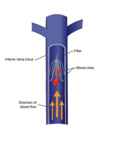 Inferior Vena Cava (IVC) Filters