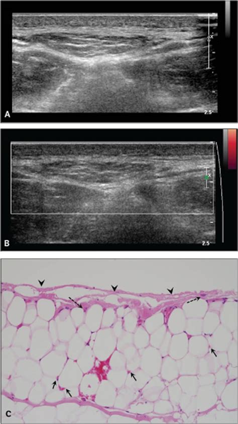 Sonographic Differentiation Between Angiolipomas and Superficial ...