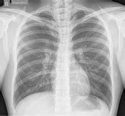 Asthma | Radiology Reference Article | Radiopaedia.org