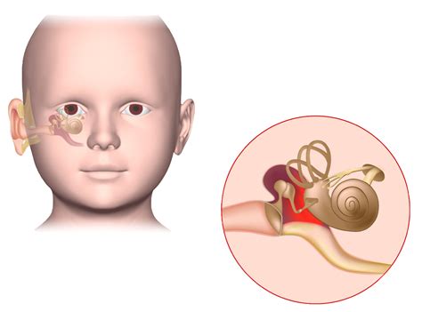 Why Glue Ear Shouldn't be Ignored - Aston Hearing Services