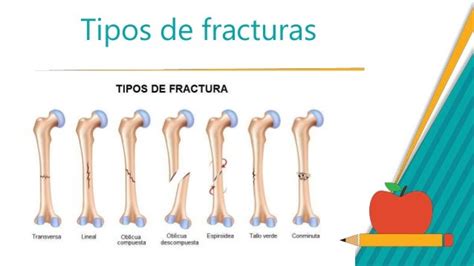 Primeros auxilios- fracturas