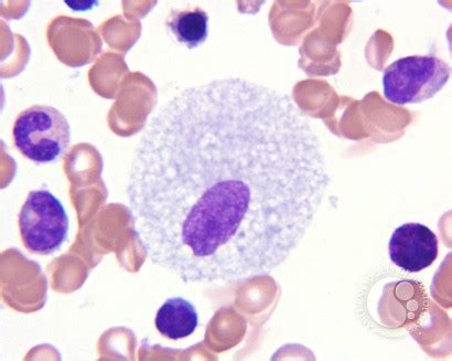 Bone marrow involvement in Niemann Pick disease - 1.