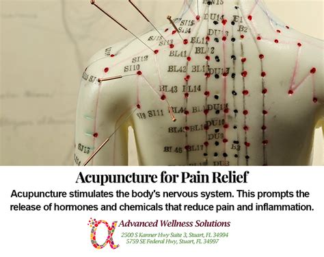 Acupuncture for Pain Relief - Advanced Wellness Solutions