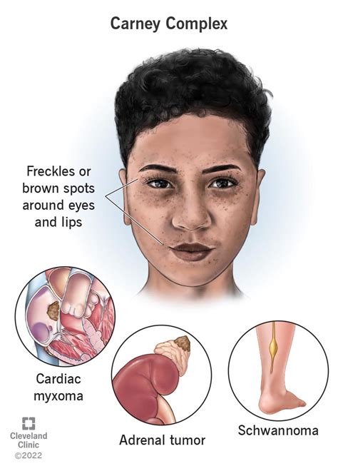 Carney Complex: What It Is, Diagnosis, Symptoms & Treatment