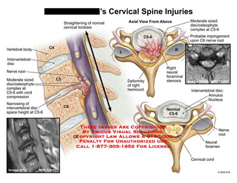 Cervical Spine Injuries