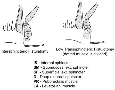 Perianal fistula causes, symptoms, diagnosis, treatment & surgery