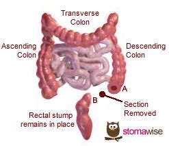 Hartmann's procedure | Stomawise | The UK Support Network for Ostomates | Ileostomy, Colostomy ...