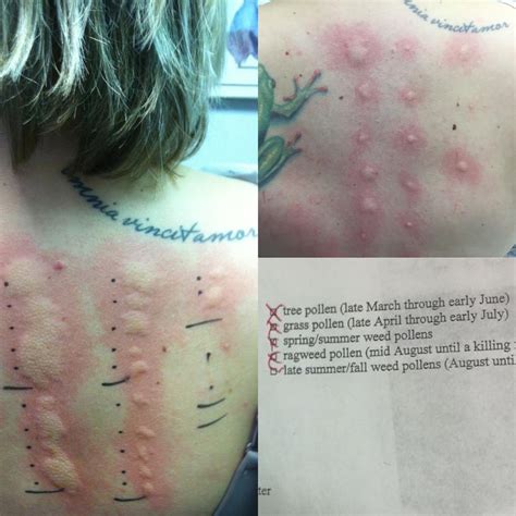 Allergy scratch tests, before (left) and after (top right) a year of immunotherapy [OC] : medizzy