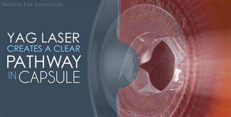 3 Myths About Cataract - Medical Eye Associates