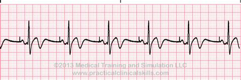 Pacemaker Single Chamber Atrial ECG Interpretation with Sample Strip