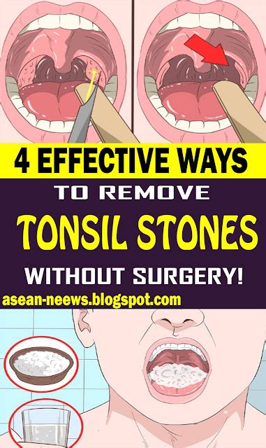 4 EFFECTIVE WAYS TO REMOVE TONSIL STONES WITHOUT SURGERY - HEALTH and WELLNESS