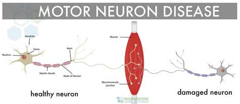 Stem Cell Treatment for Motor Neuron Disease MND