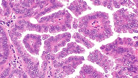 Adenocarcinoma: Types, Causes, Symptoms, and Treatment – Entirely Health