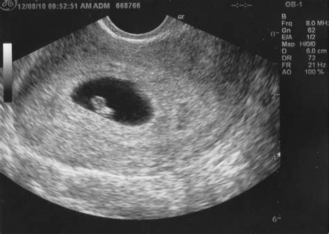 Ultrasound 6 Weeks Pregnant With Twins Symptoms