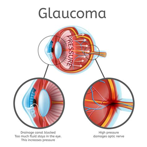 Glaucoma in Myopia: Diagnostic Dilemmas - Review of Myopia Management