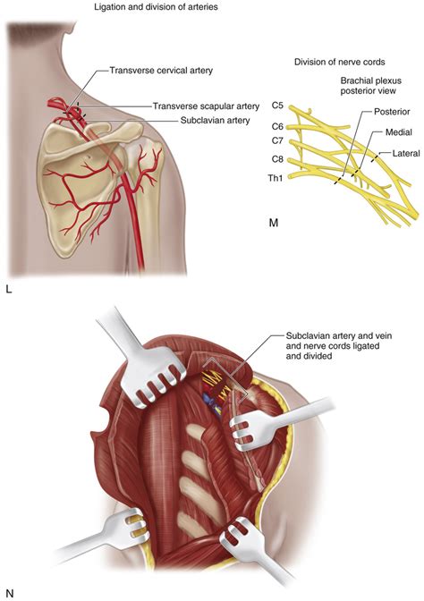 67 Posterior Approach for Forequarter Amputation (Littlewood Technique) | Musculoskeletal Key