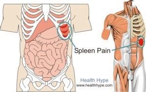 Spleen Pain Location, Pictures, Symptoms and Causes | Healthhype.com